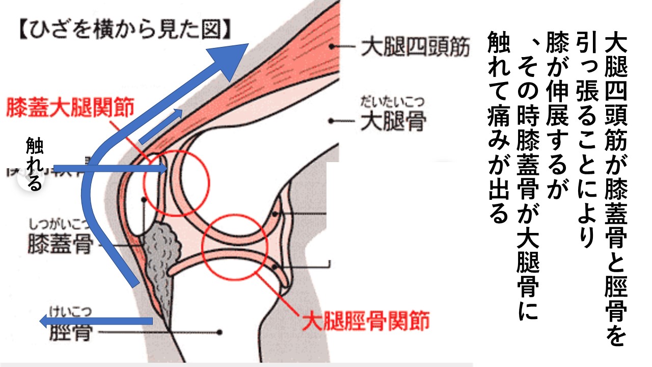 若い人の膝の痛み 膝蓋大腿関節症 東邦マッサージグループ 若い人の膝の痛み 膝蓋大腿関節症 東邦マッサージグループ